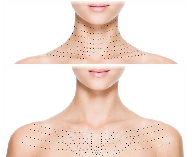 Märkning på huden på halsen och dekolletage för föryngrande biorevitalisering
