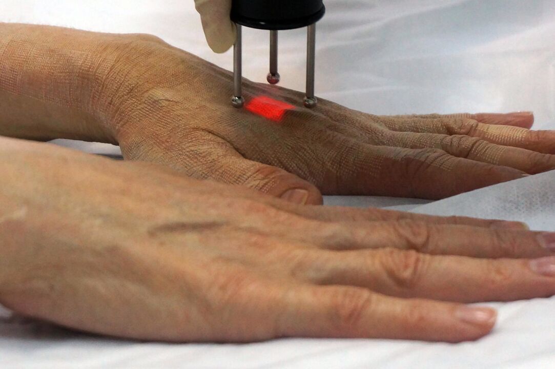 Laserföryngring av händerna med en icke-ablativ metod