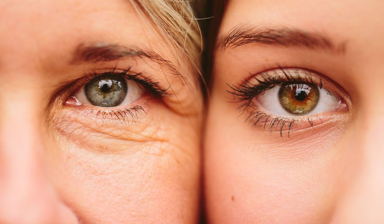 tecken på åldrande runt ögonen
