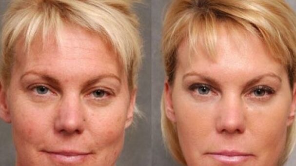 Före och efter föryngringsförfarandet