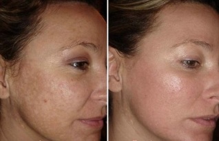laser ansikts hudföryngring före och efter foton